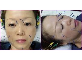 美容鍼の効果