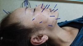 美容鍼のうれしい報告②